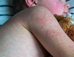 Measles Information